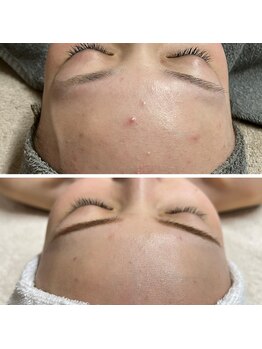 カンフリエ 吉野ヶ里店(Camphrier)/ハーブピーリング