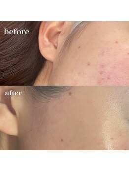 エヌドットエヌ(_n.n_)/フェイシャルWax一回