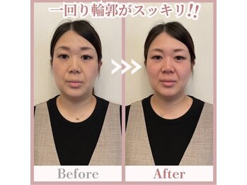 ヨサパーク レナータ(YOSA PARK Renata)/水素酸素吸入30分の変化♪