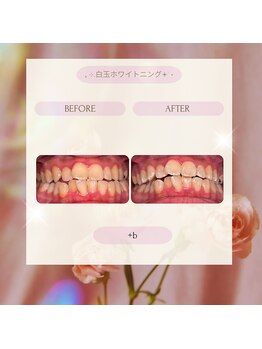 プラスビーセルフ(+b self)/ホワイトニングビフォーアフター