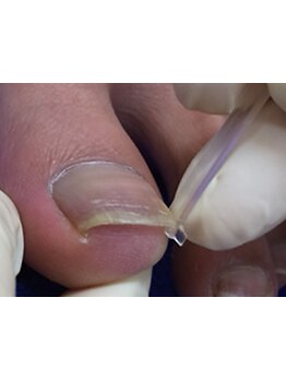 フットケアを受けたい