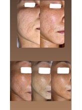 エミナル(EMINALu)/毛穴詰まりも解消