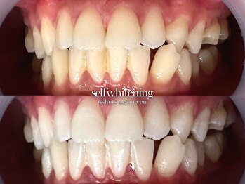 ココロビューティーギャラリー 武蔵小杉(cocorobeauty gallery)/ホワイトニング★初回6照射