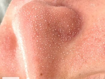 オンユ(ON’U)の写真/【ゴッソリ浮かしてしっかり吸引！】ざらつき、毛穴のお悩みに徹底アプローチ！ハイドラフェイシャル♪