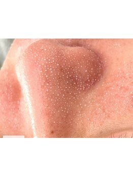 毛穴ケアをしたい