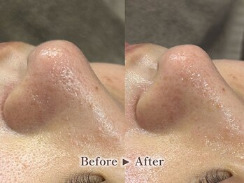 リテルナ(Re.terna)/■毛穴洗浄・毛穴ケアコース