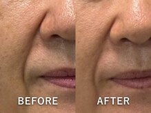 ビーホープ(B.hope)/60代モニター様2回目