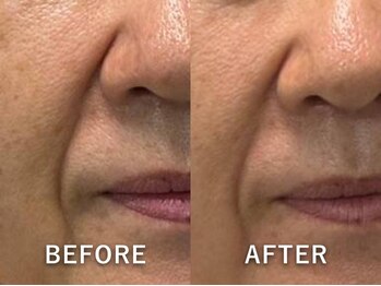 ビーホープ(B.hope)/60代モニター様2回目