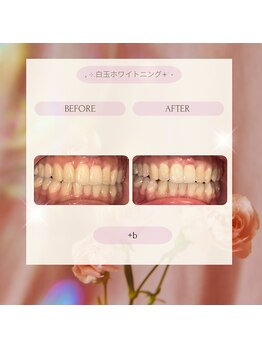 プラスビー 3号店(+b)/ホワイトニングビフォーアフター