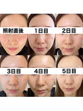 ベルファーム(Belle Femme)/大人気！シミケア♪　