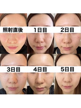 ベルファーム(Belle Femme)/大人気!シミケア♪