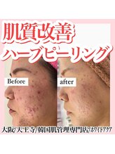 ホワイトアクア 天王寺本店(WHITE AQUA)/ハーブピーリング/大阪/天王寺