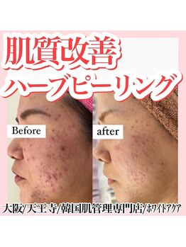 ホワイトアクア 天王寺本店(WHITE AQUA)/ハーブピーリング/大阪/天王寺