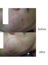 アップルミント/＜フェイシャル＞before・after