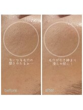 ペルラペティーユ(PERLA PETILLER)/ダイヤモンドピーリング