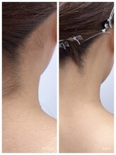 サロンシルク(salon silc)/うなじ脱毛