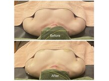 ベンザイ 梅田店(BENZAI)/巻肩、バストUP