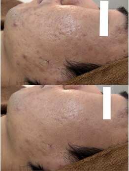 リートライ(Re Try)/ハーブピーリング