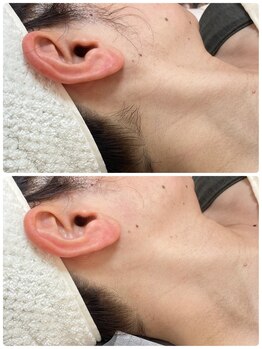 エクボ(EcBeau)/うなじ脱毛といえばエクボ