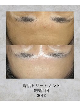 コンクパール(CONCH PEARL.)/陶肌トリートメント