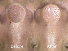 肌再生×改善サロン Unica の雰囲気(毛穴ごっそり水素洗浄1回)