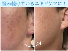 トータルビューティー ココ(Total Beauty CoCo)の雰囲気（肌悩みを丁寧にカウンセリングし改善に導くサポートを行います。）
