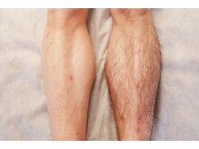 ベルヴィー(Belle vie)/メンズ脱毛☆脚脱毛