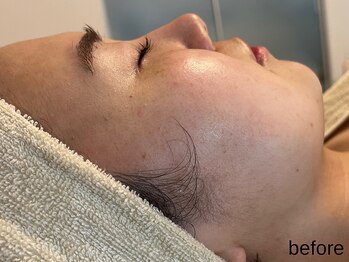 サロン ド エメ(salon de aimer)/【Before】毛穴、くすみに♪