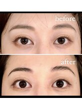 アズール(azure)/小顔矯正でリフトアップ