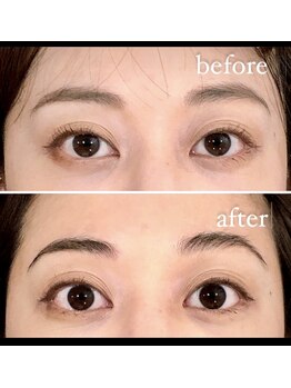 アズール(azure)/小顔矯正でリフトアップ