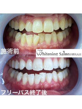 ホワイトニングサロン 京都烏丸店/ホワイトニング施術例