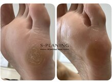 ロンディネ(Rondine)/韓国式足裏角質ケア