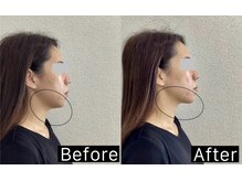 ワイ(Y)/エクソソーム導入で横顔美人に！