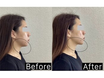 ワイ(Y)/エクソソーム導入で横顔美人に!