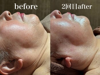 ディアーム 光明池店(Diarm)/韓国式脂肪分解レッドショット