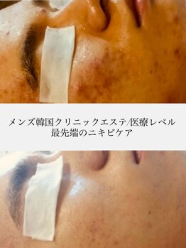 アール(R)の写真/【メンズ専門サロン/香里園】寝屋川発！美容大国の韓国エステをアールで体感ください/即日効果実感/男美容