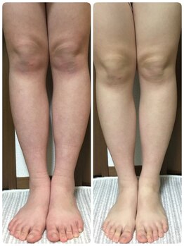 新リンパサロン 大阪/むくみにテキメン！！