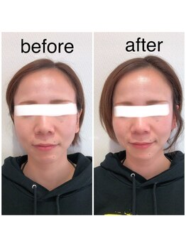 カイロプラクティック ネクサス/顔の歪み撃退☆