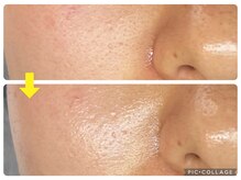 アルマ(ALMA)/しつこい鼻の黒ずみもお任せ！