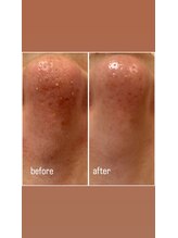 プライベートサロン アール(R)/毛穴洗浄のビフォーアフター