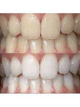 ホワイトニングセンター うるま江洲店/沖縄市・うるま市ホワイトニング