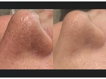 ピービー(PB)の雰囲気（結果満足度99.5%!!医療提携/ニキビ改善/毛穴改善/シワたるみ改善）