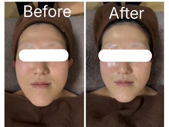 肌質改善 Laviere Flora【ラヴィエール フローラ】/フェイシャル半年コース