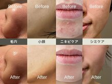 ルディラ医療提携エステ 立川店 毛穴/小顔/ニキビ・シミ・美白・シワ・たるみケア/ルディラ医療提携エステ