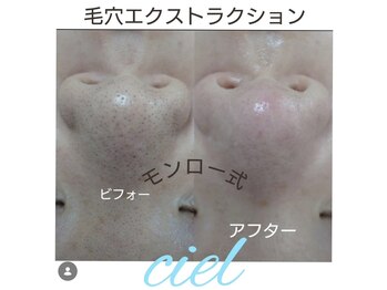 シエル(Ciel)の写真/汚れた毛穴はもういらない！憧れの毛穴レス肌へ！毛穴エクストラクションでいちご鼻解消！♪