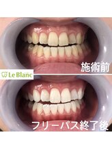 ルブラン 奈良店(Le Blanc)/歯の大掃除も！！