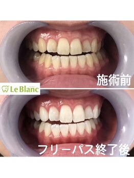 ルブラン 奈良店(Le Blanc)/歯の大掃除も！！