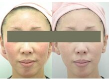 ヒフミ(hifumi.)/復元パック☆症例３