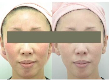 ヒフミ(hifumi.)/復元パック☆症例３