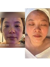 モア(MOA)/小顔リンパマッサージ